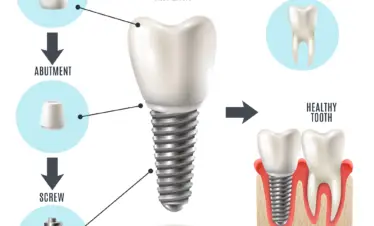 What is dental implant