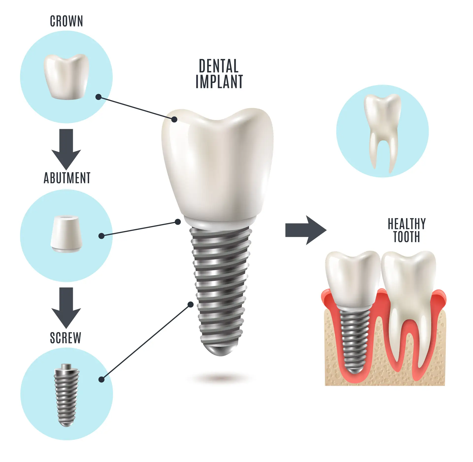 What is dental implant