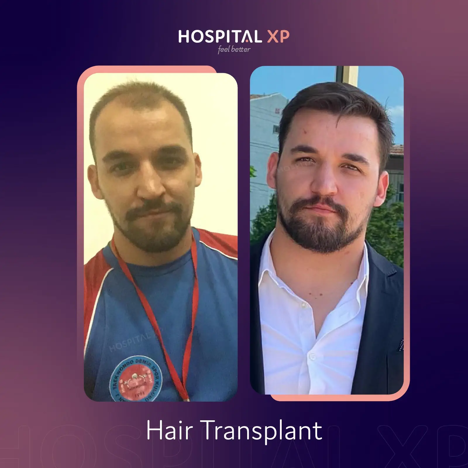 Choi Pen DHI Hair Implant in Istanbul, Turkey by Hospital XP Healthcare Group