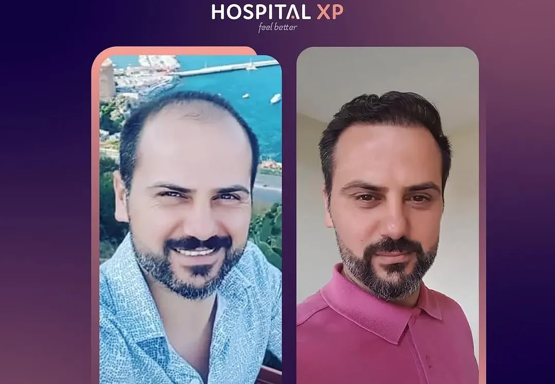 Choi Pen DHI Hair Implant in Istanbul, Turkey by Hospital XP Healthcare Group