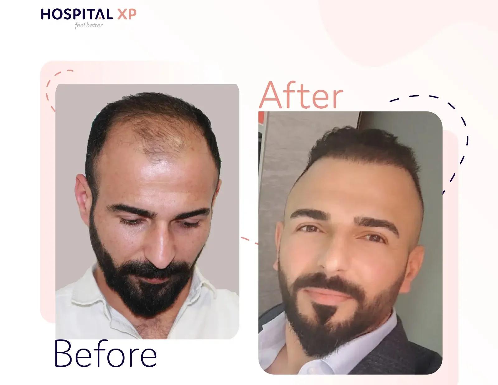 Choi Pen DHI Hair Implant in Istanbul, Turkey by Hospital XP Healthcare Group