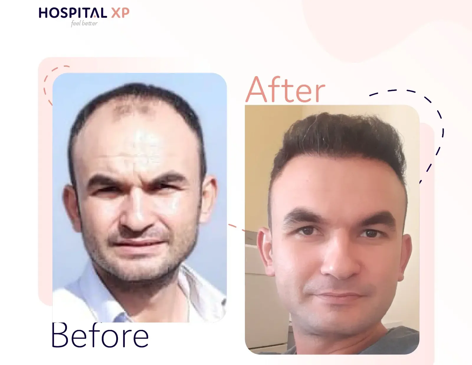 Choi Pen DHI Hair Implant in Istanbul, Turkey by Hospital XP Healthcare Group