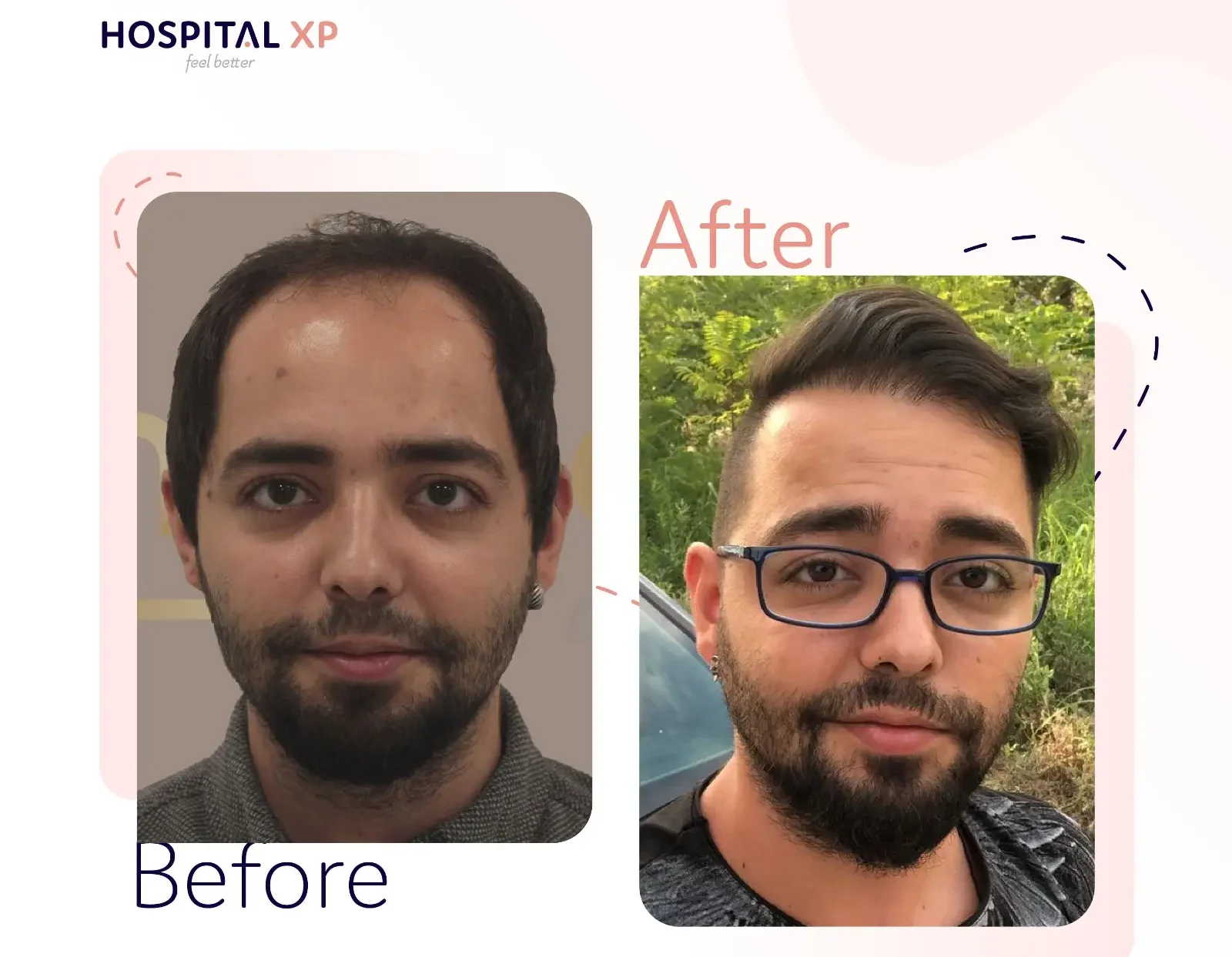 Choi Pen DHI Hair Implant in Istanbul, Turkey by Hospital XP Healthcare Group