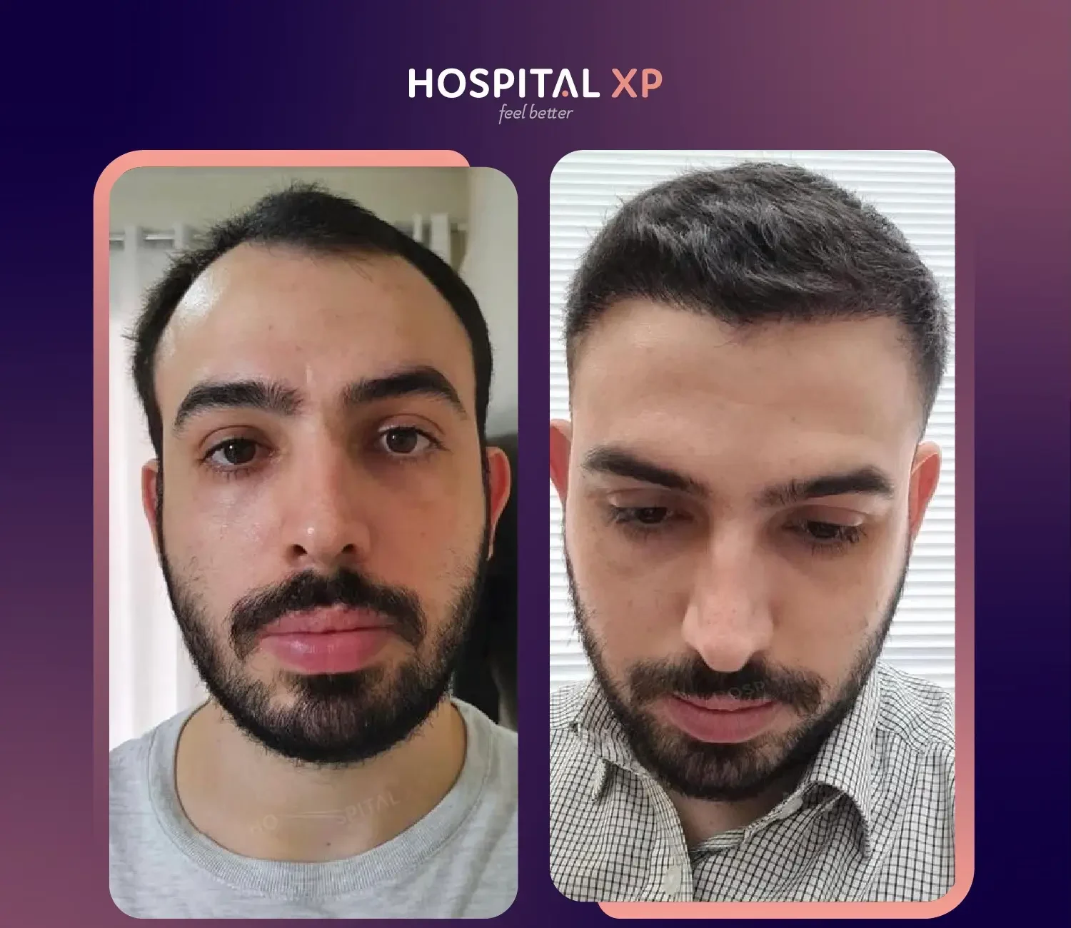 Choi Pen DHI Hair Implant in Istanbul, Turkey by Hospital XP Healthcare Group