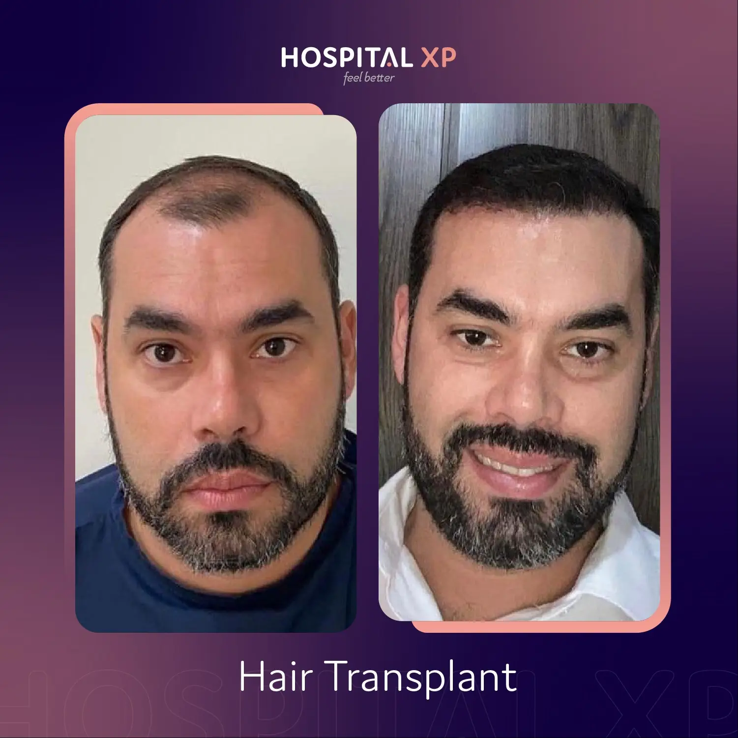Choi Pen DHI Hair Implant in Istanbul, Turkey by Hospital XP Healthcare Group