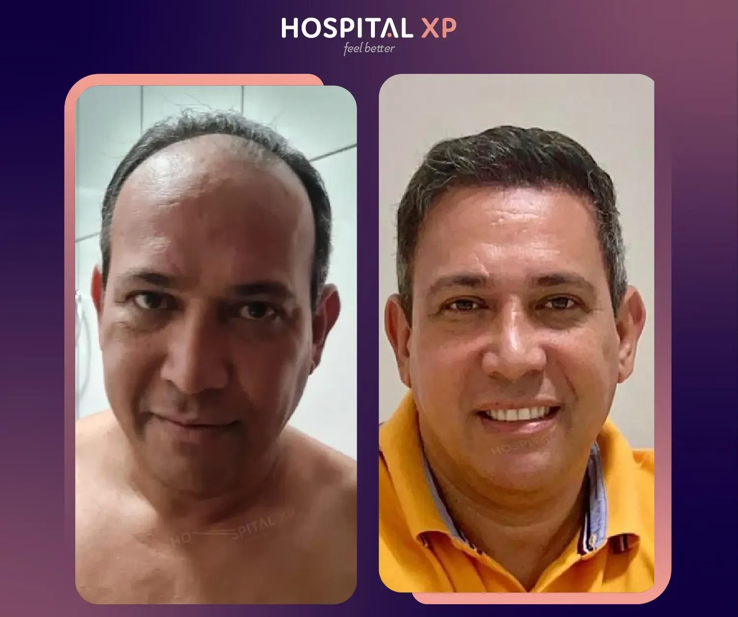 Choi Pen DHI Hair Implant in Istanbul, Turkey by Hospital XP Healthcare Group