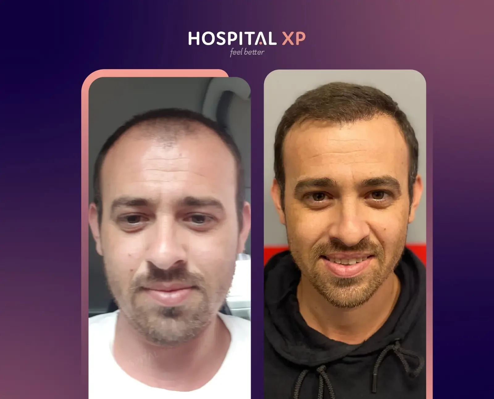 Choi Pen DHI Hair Implant in Istanbul, Turkey by Hospital XP Healthcare Group