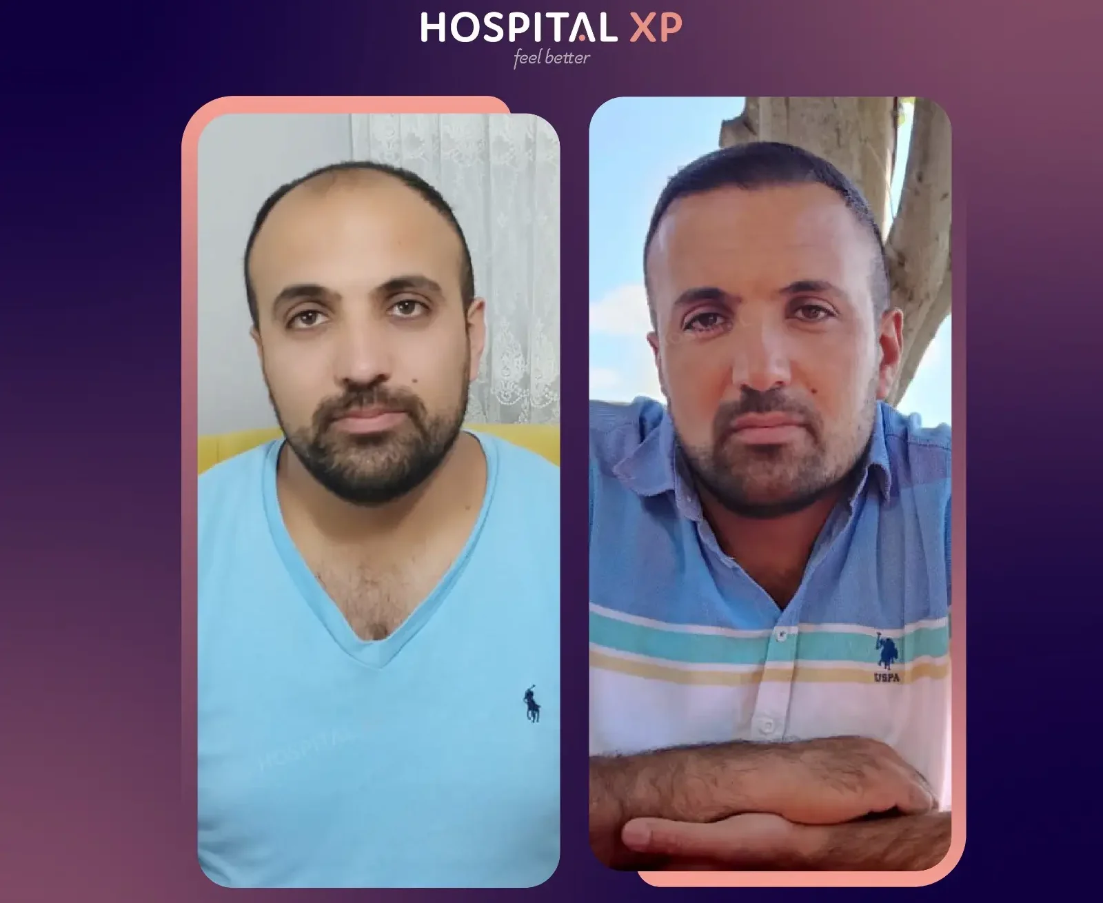 Choi Pen DHI Hair Implant in Istanbul, Turkey by Hospital XP Healthcare Group