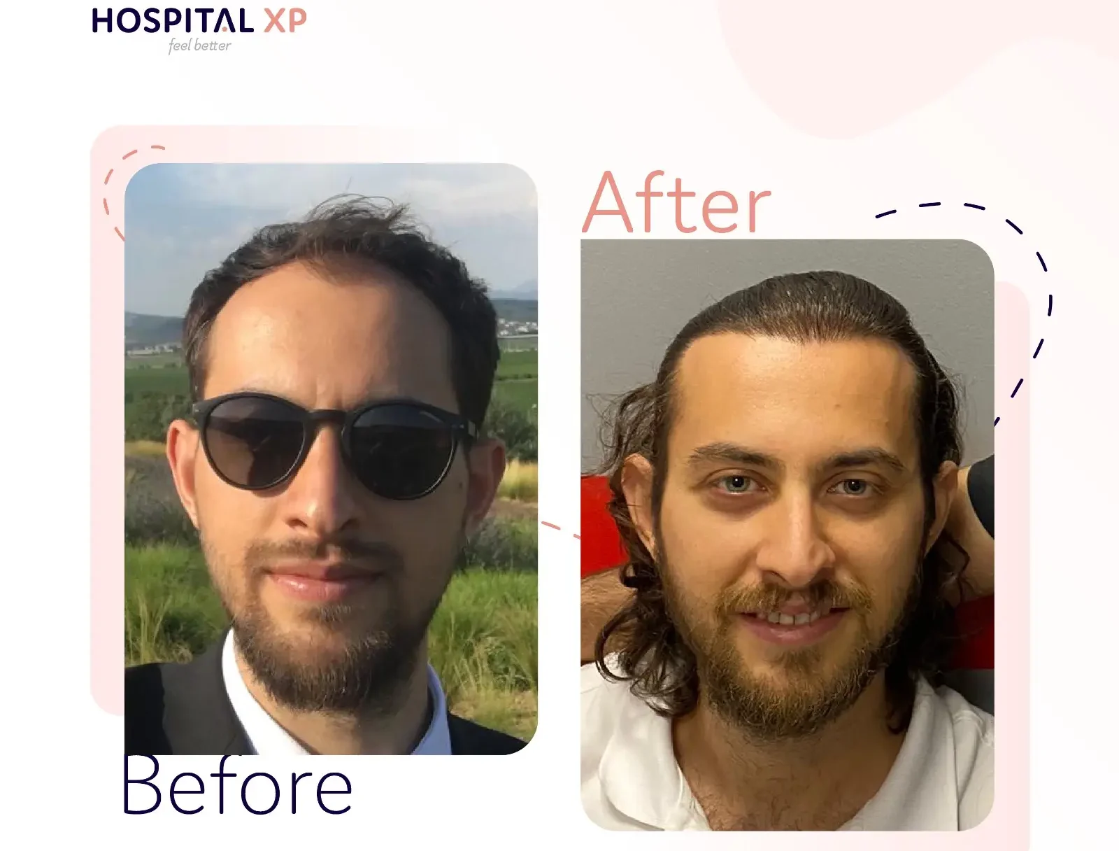 Choi Pen DHI Hair Implant in Istanbul, Turkey by Hospital XP Healthcare Group
