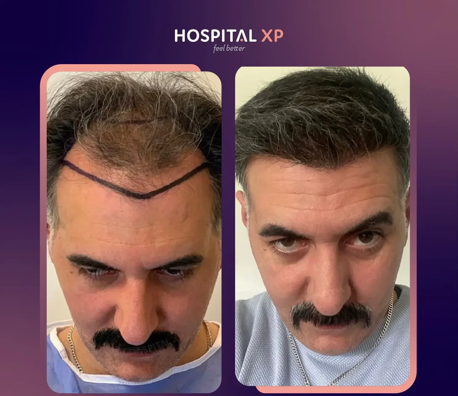 Choi Pen DHI Hair Implant in Istanbul, Turkey by Hospital XP Healthcare Group