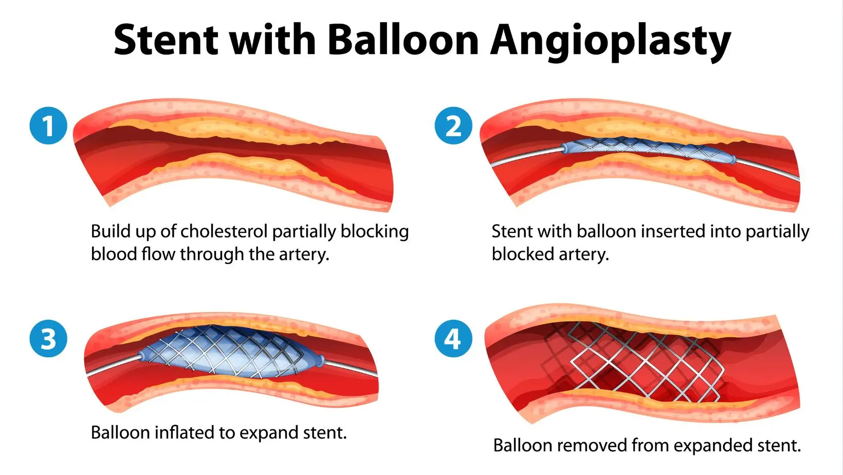 Cardiovascular Surgery in Brazil