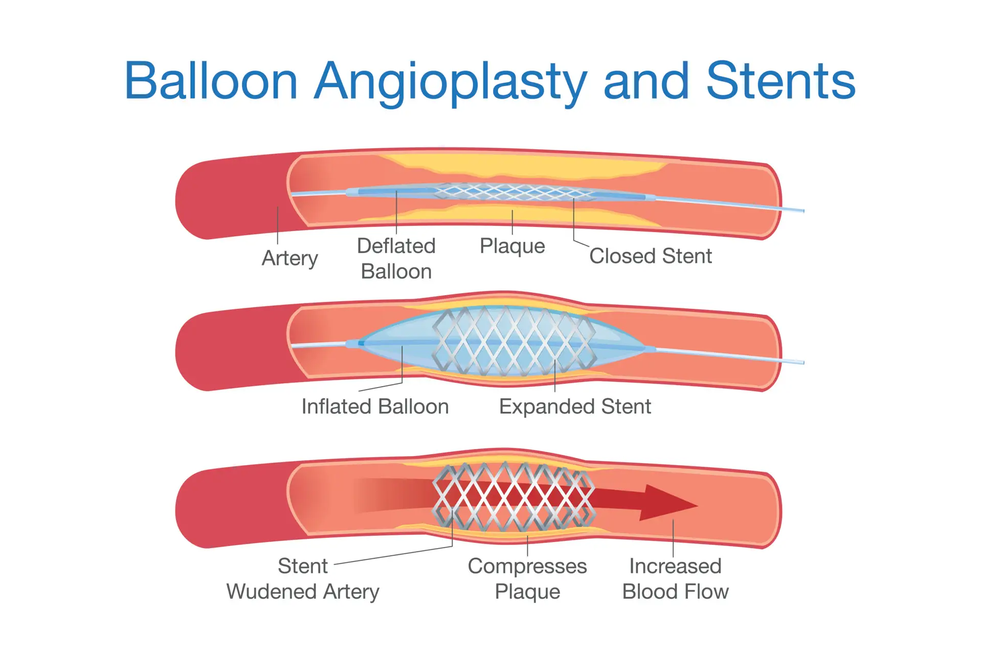Coronary Angioplasty and Stenting in Panama