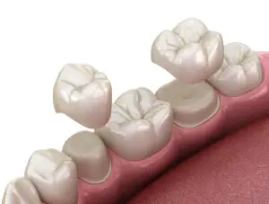 Dental Crown Clinics and Procedures Abroad