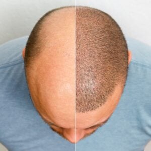 Hair Restoration Surgery
