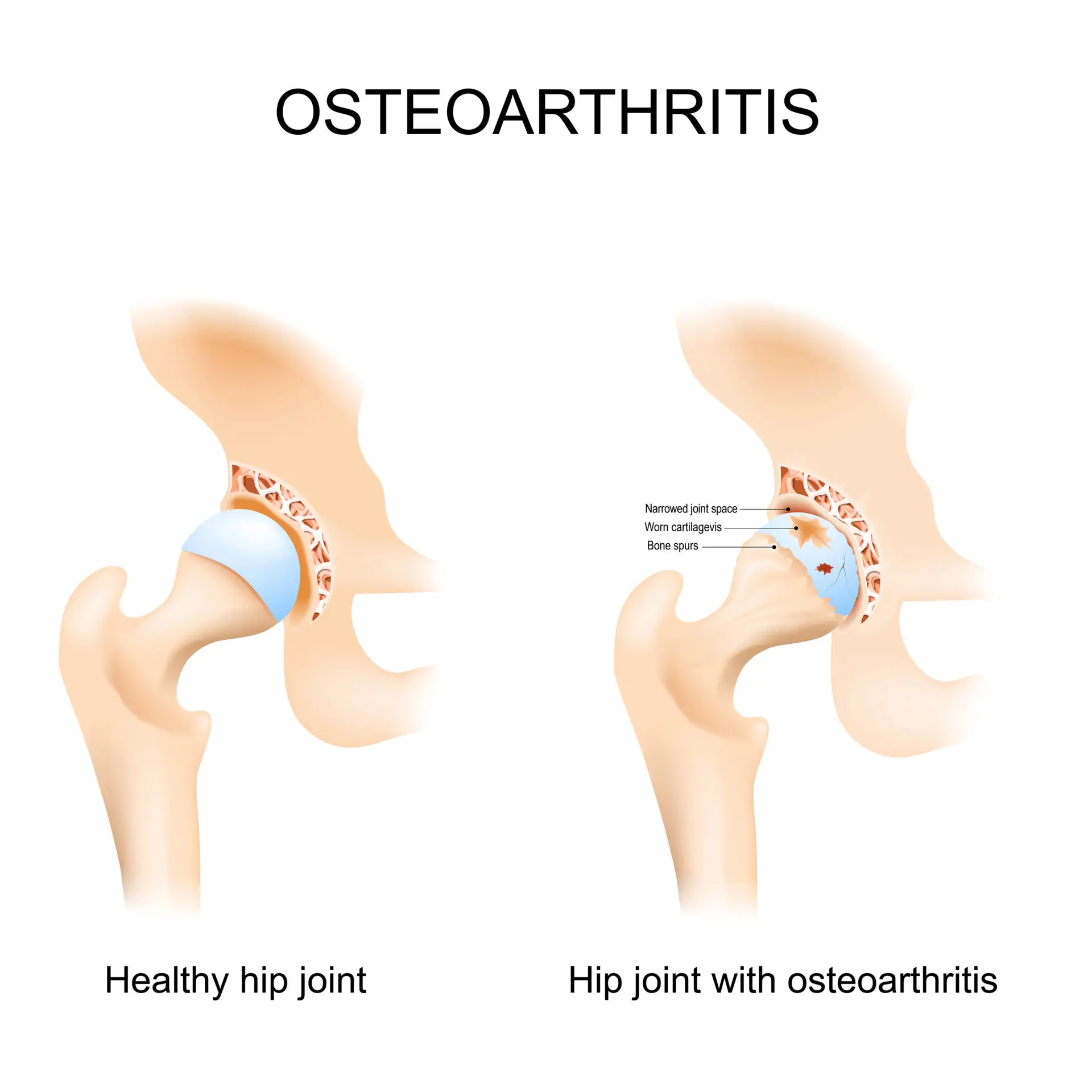 Hip Replacement in Sao Paulo, Brazil