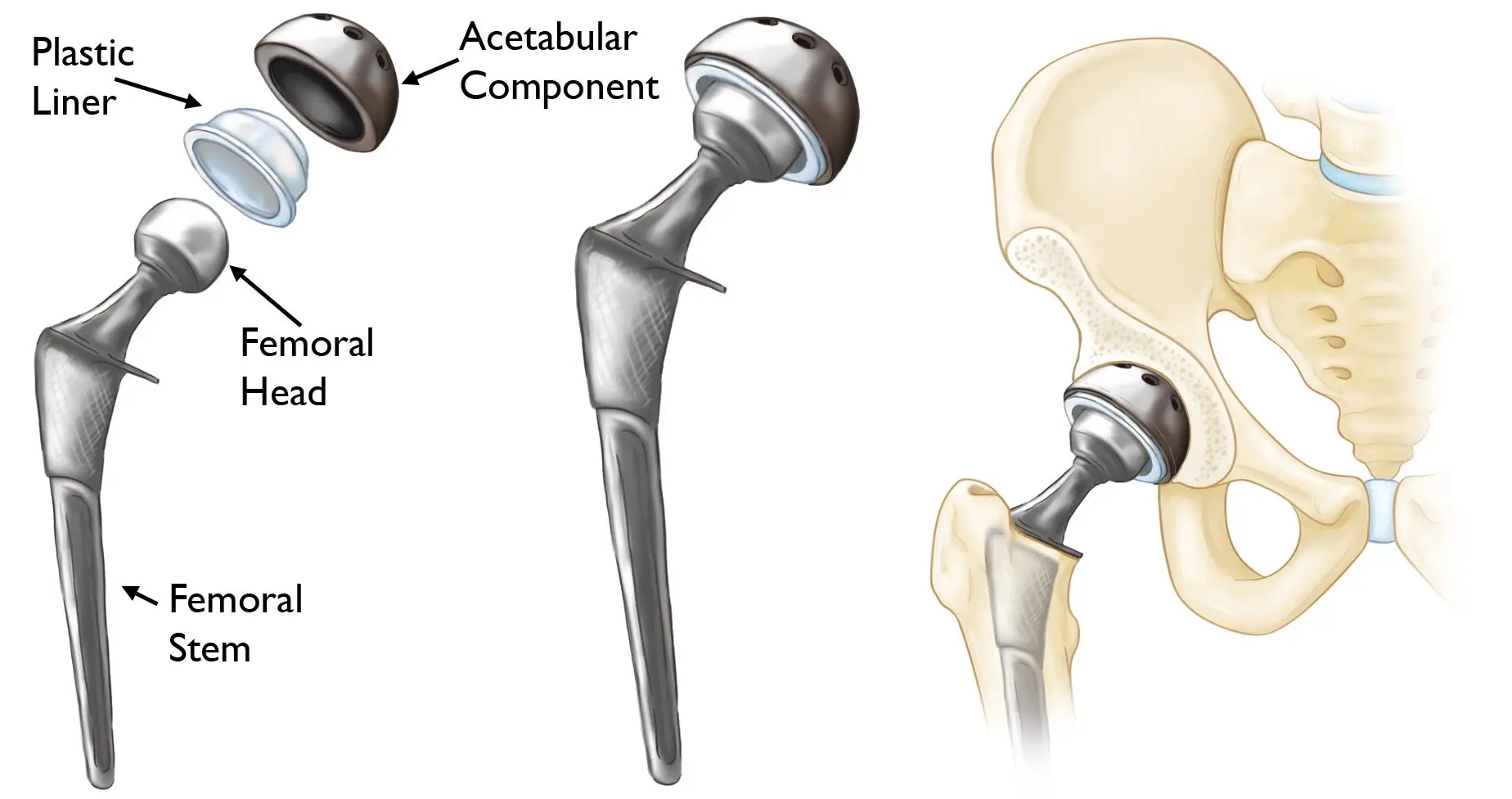 Hip Replacement in Sao Paulo, Brazil