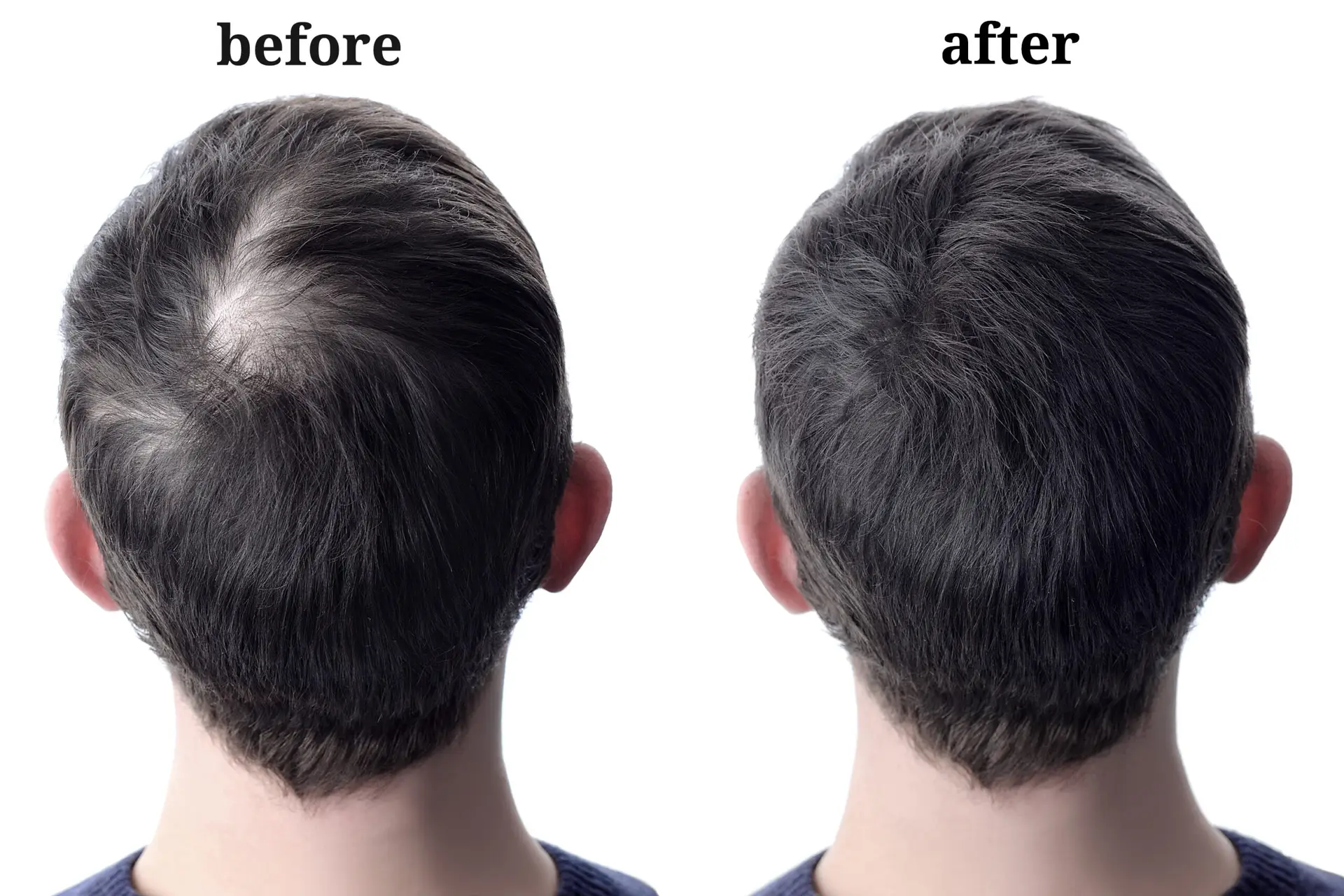 Hair Transplant in Dubai