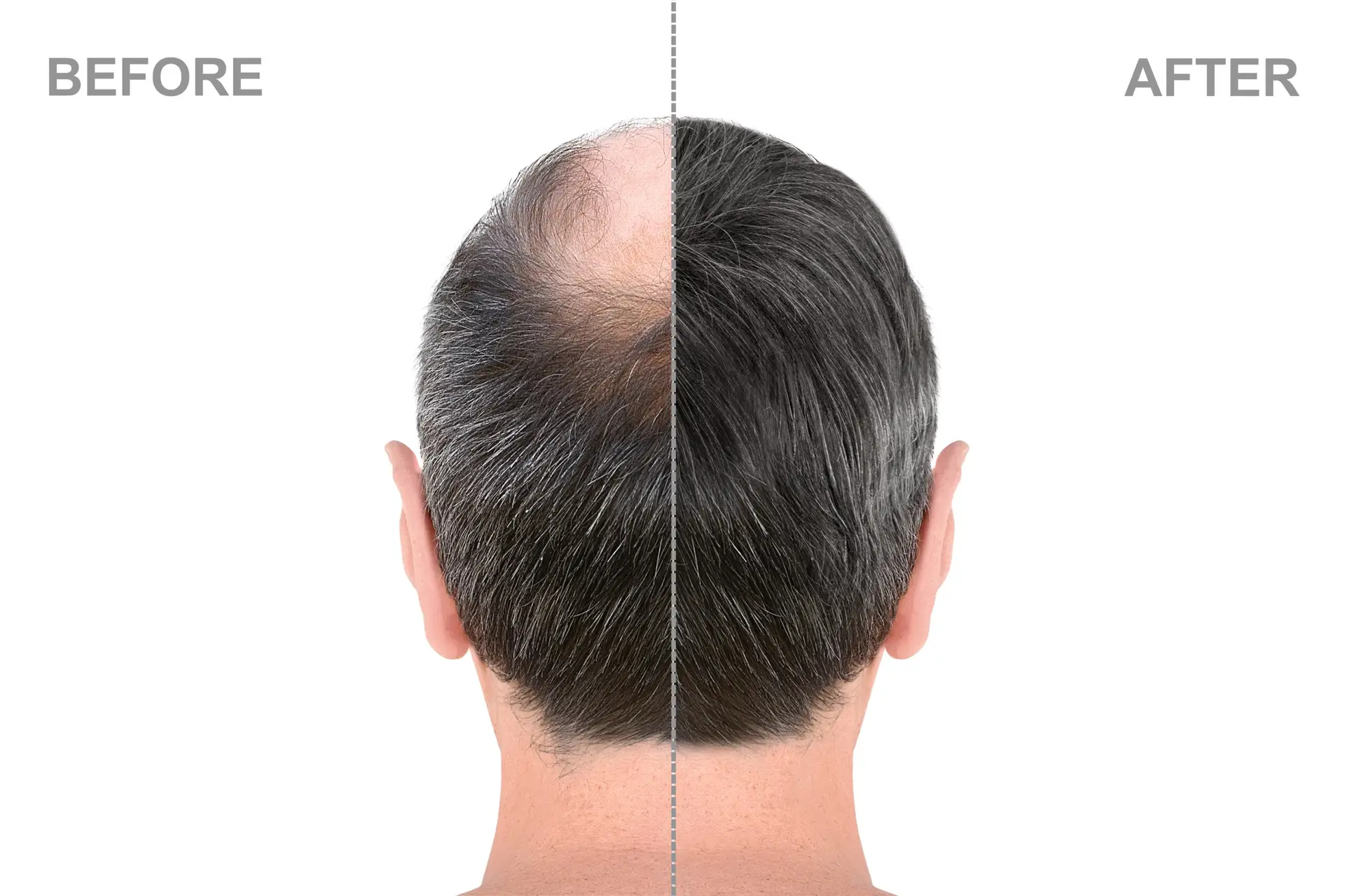 Hair Transplant in San Jose