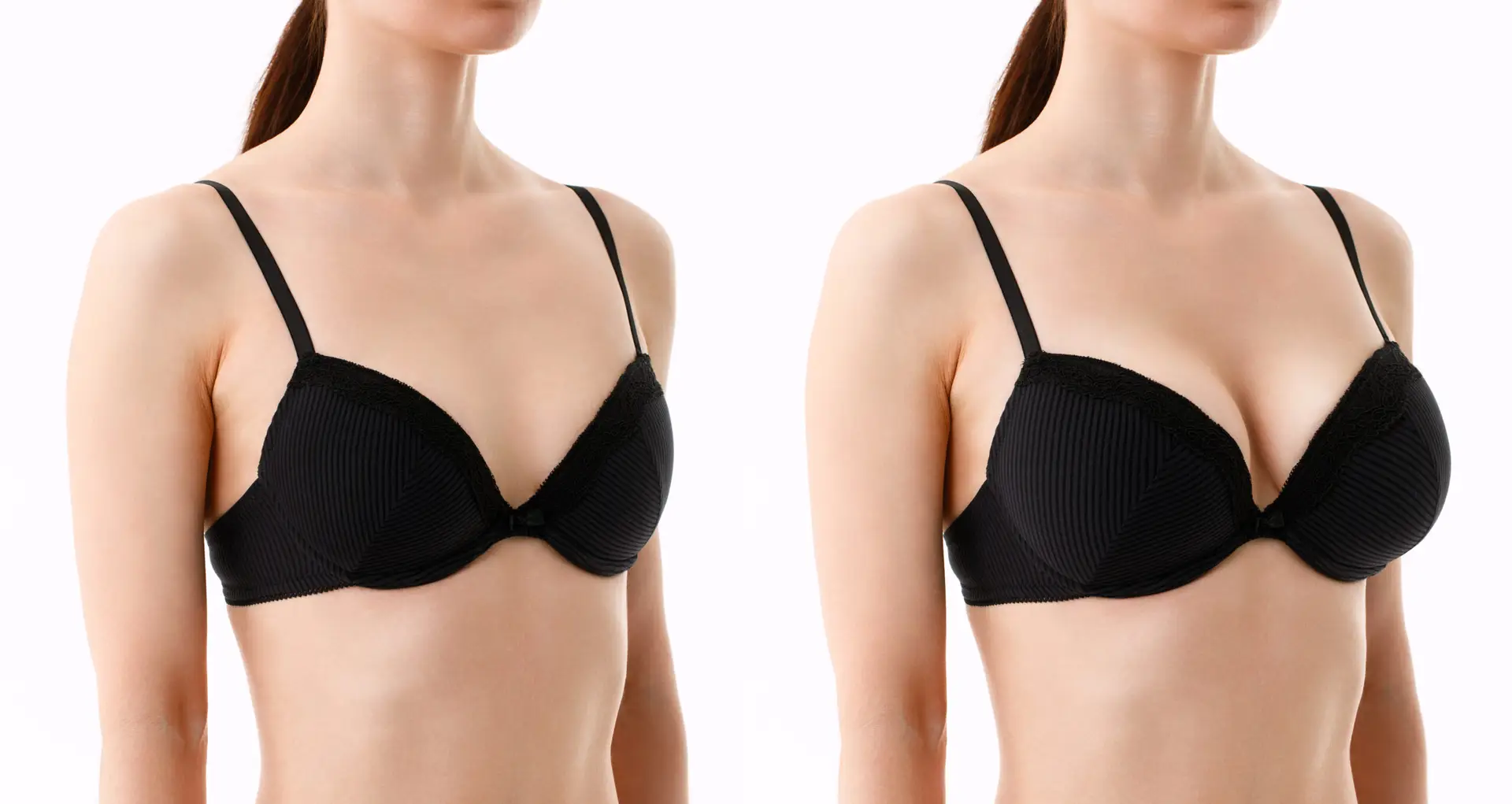 Breast Augmentation in Rio de Janeiro, Brazil
