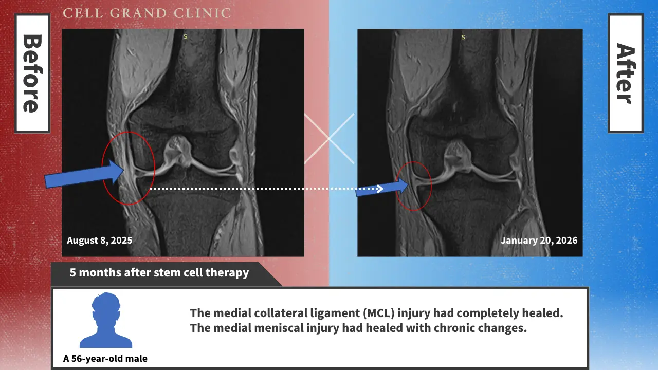 Knee Pain in Osaka, Japan by Cell Grand Clinic