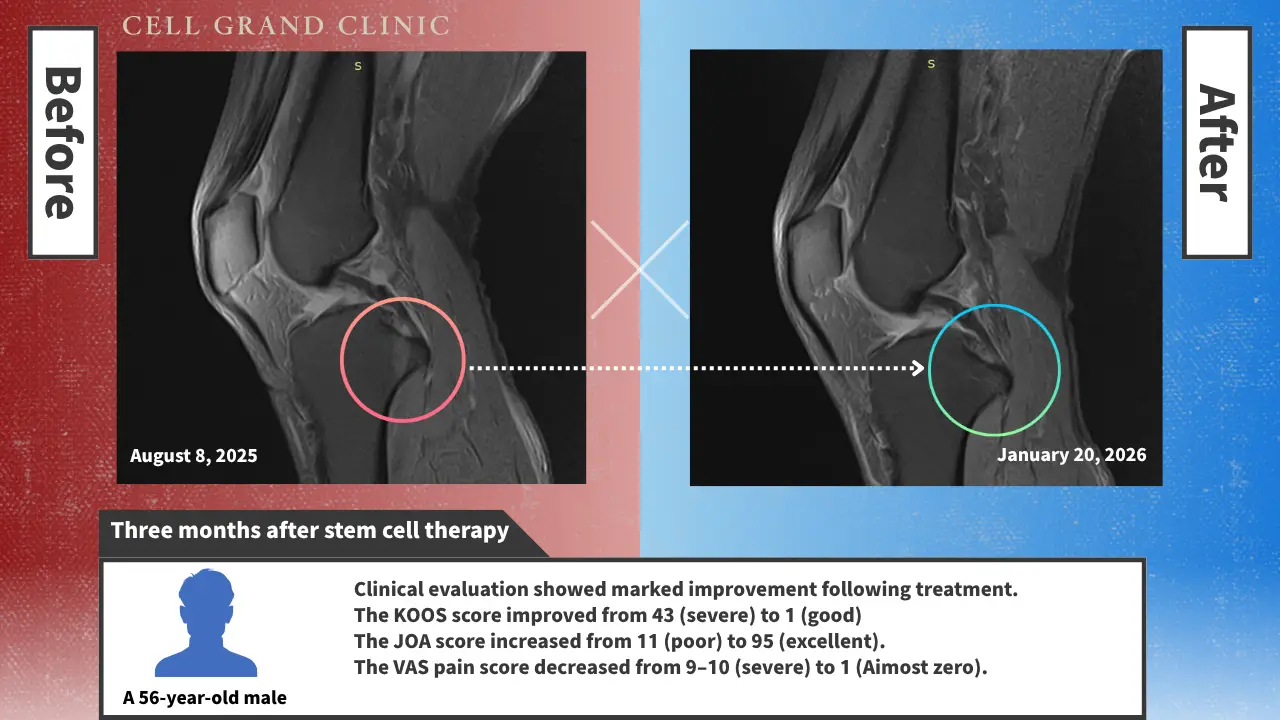Knee Pain in Osaka, Japan by Cell Grand Clinic