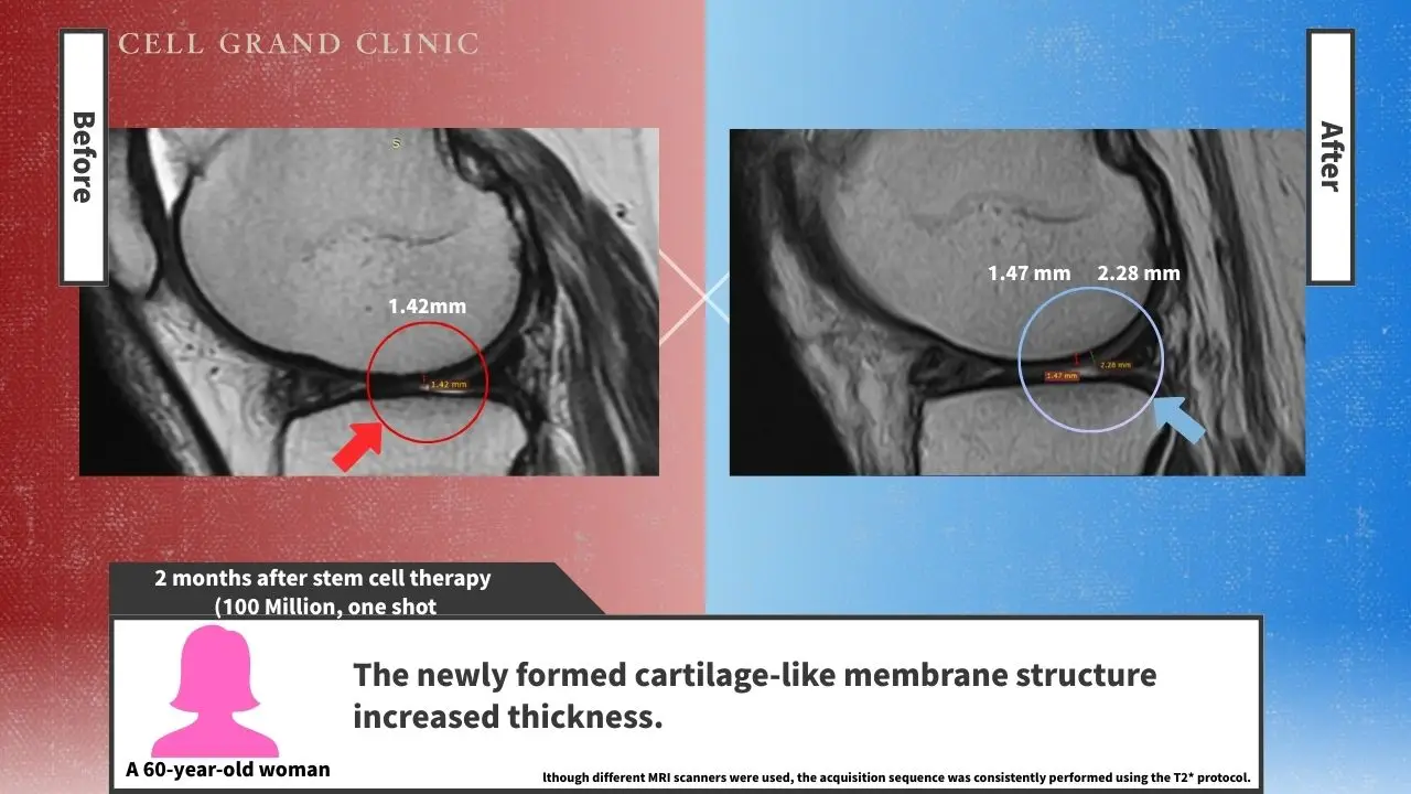 Knee Pain in Osaka, Japan by Cell Grand Clinic