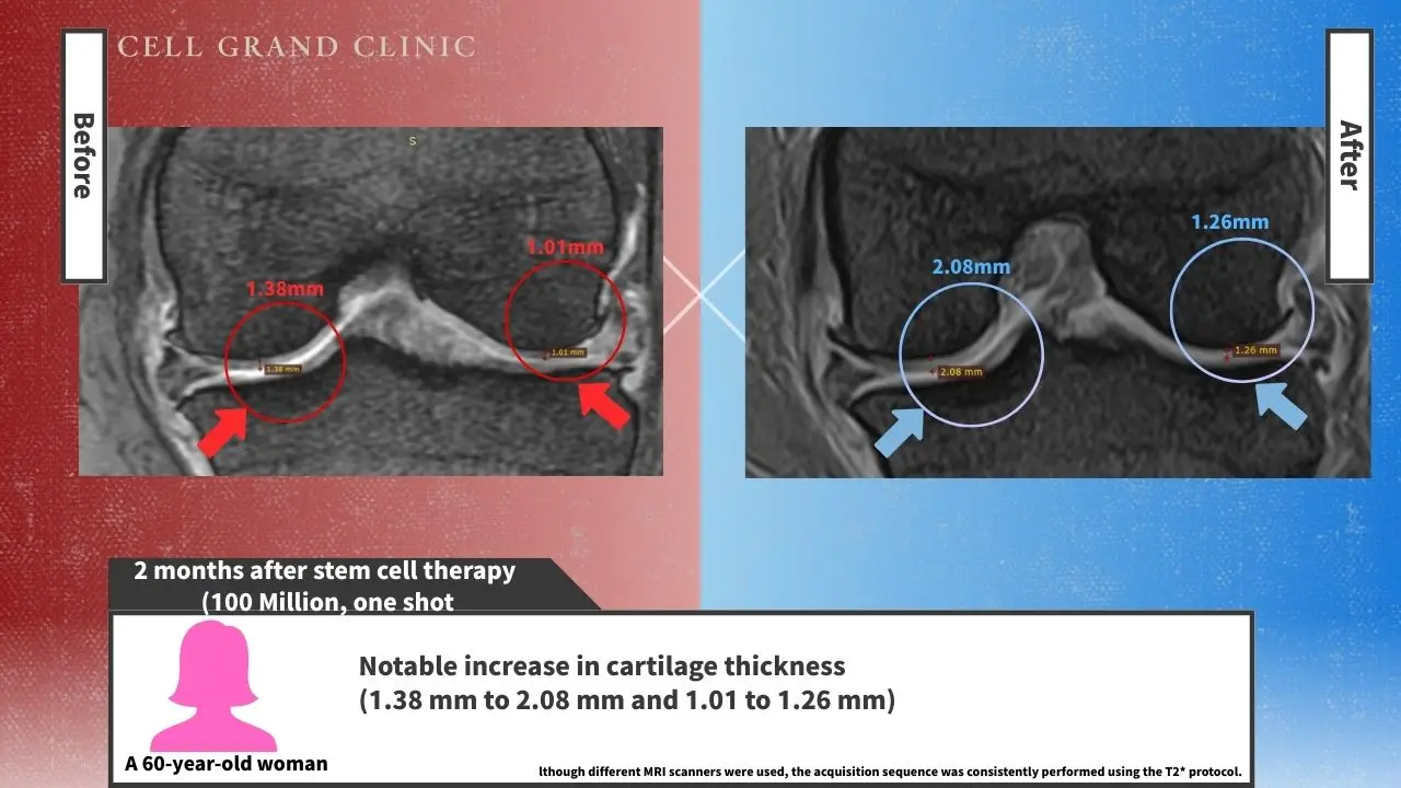 Knee Pain in Osaka, Japan by Cell Grand Clinic
