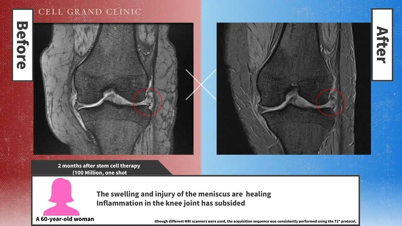 Knee Pain in Osaka, Japan by Cell Grand Clinic