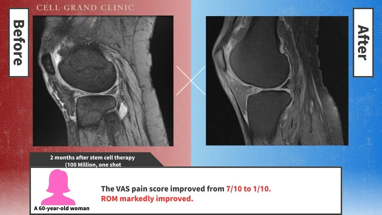 Knee Pain in Osaka, Japan by Cell Grand Clinic