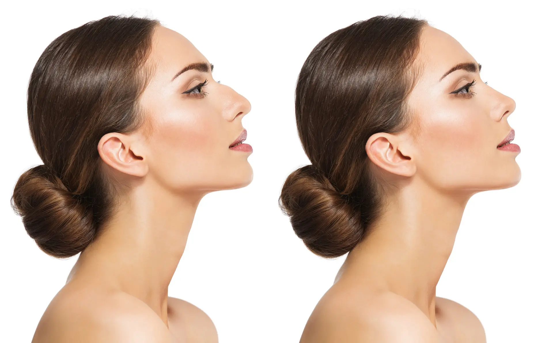 Rhinoplasty Procedure in San Jose