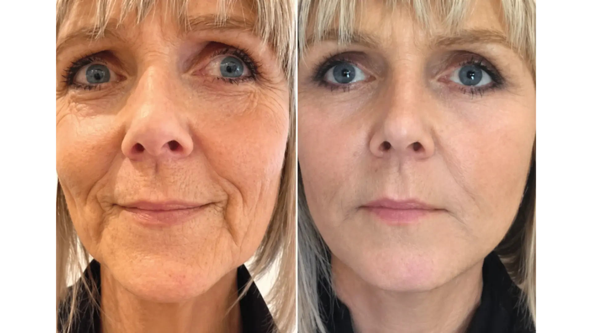Treatments to Combat Sagging Skin in Mexico City, Mexico by Jose Cortes Institute