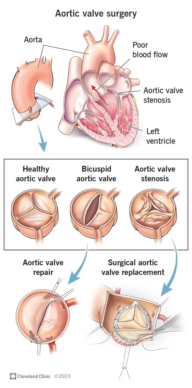 Heart Valve Disease Treatment in Panama