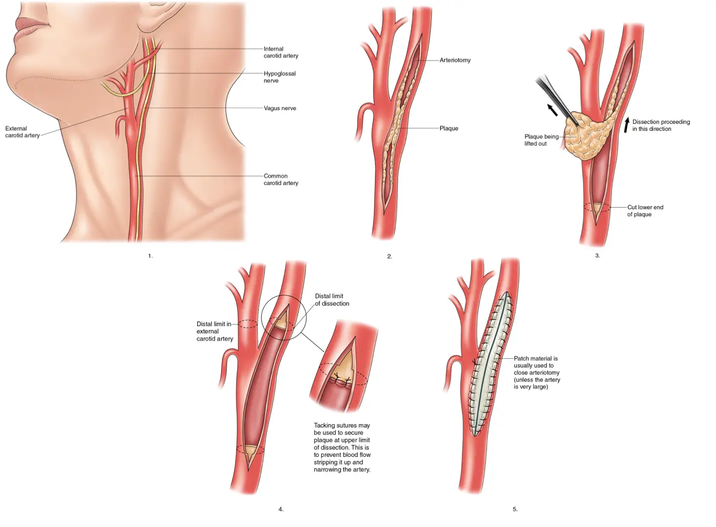 Carotid Artery Surgery in Turkey