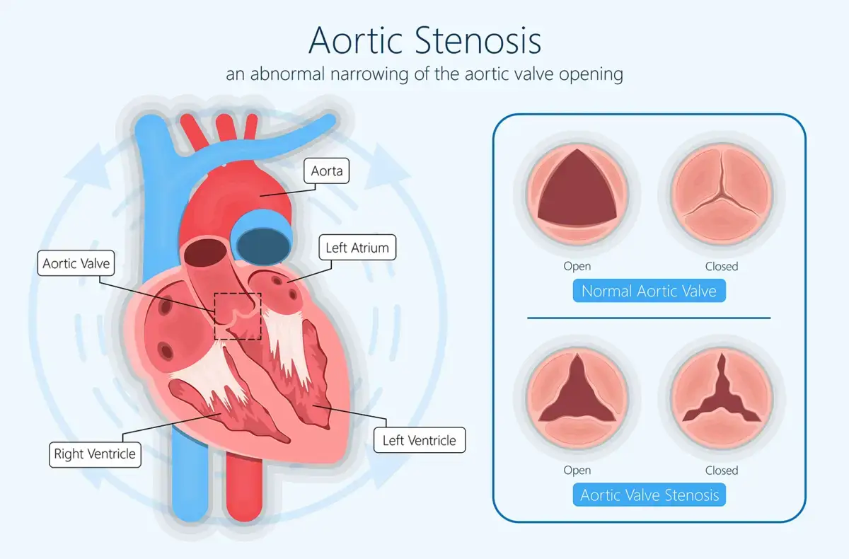 Heart Valve Surgery in Istanbul