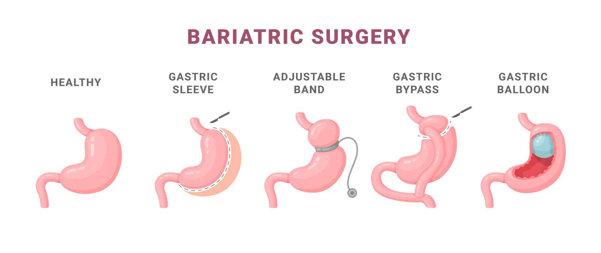 Bariatric Surgery in Dubai — Procedure Gallery Photo