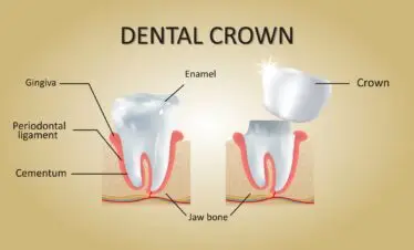 Dental Crown
