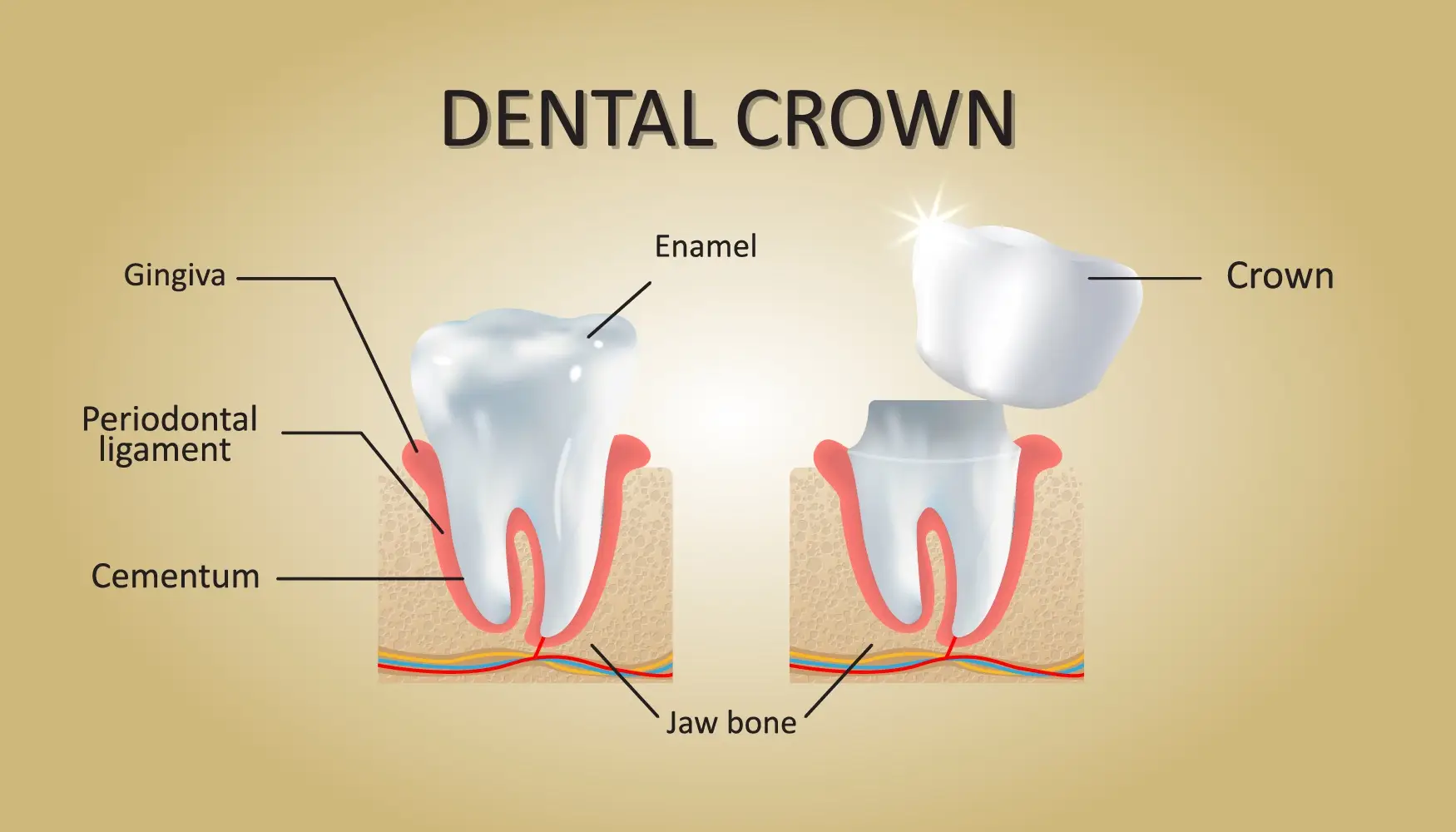 Dental Crown