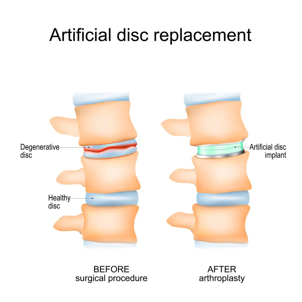 Medical illustration showing spine before and after artificial disc replacement, comparing degenerative disc removal with artificial implant insertion