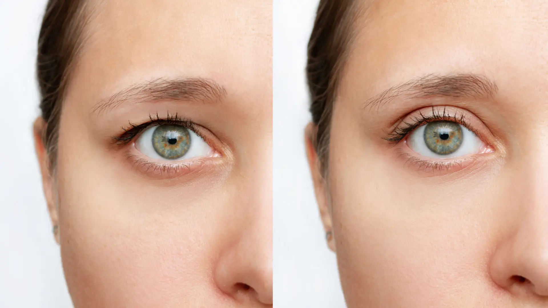 Face and Eyelid Aesthetics Surgery in Turkey