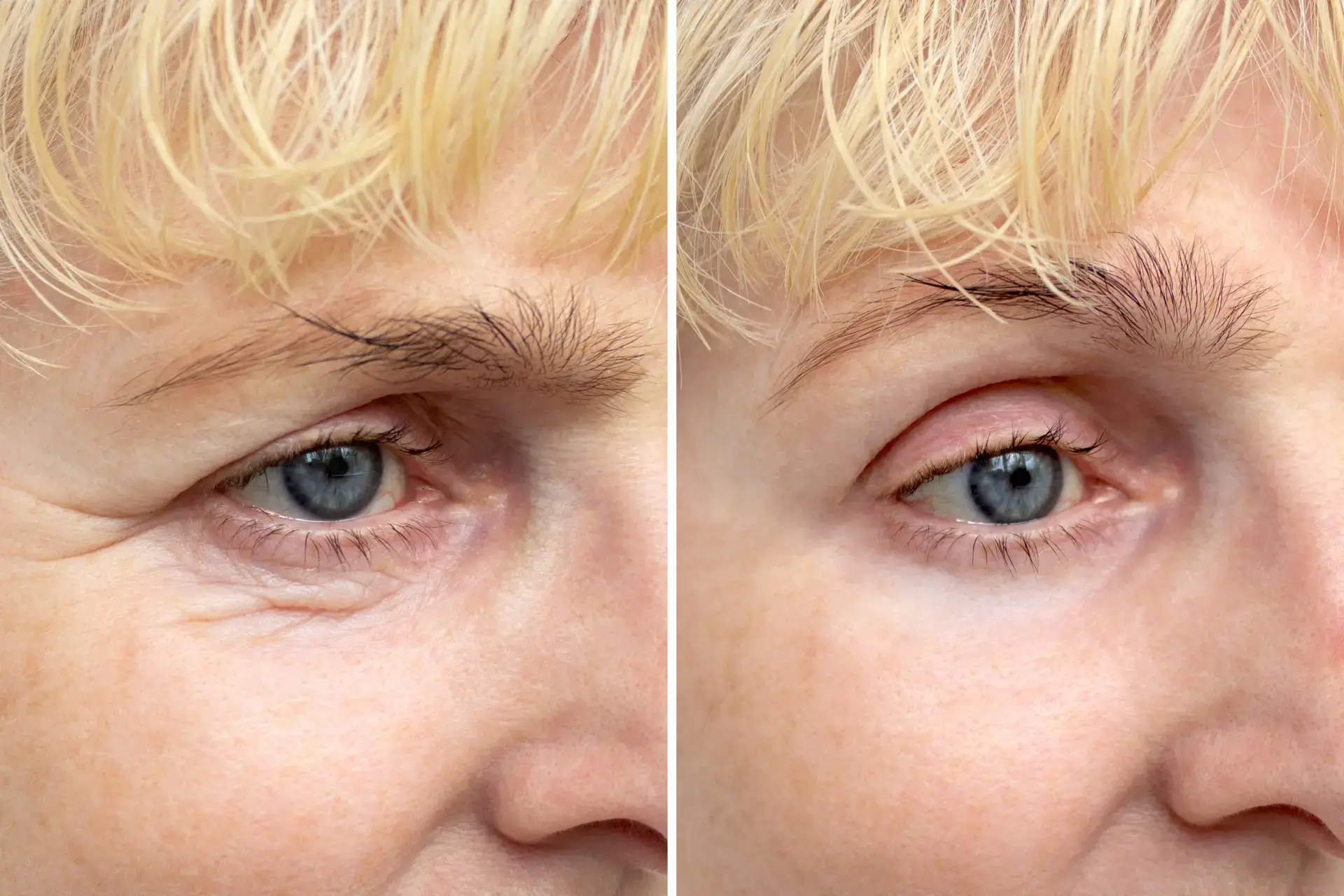 Face and Eyelid Aesthetics Surgery in Turkey