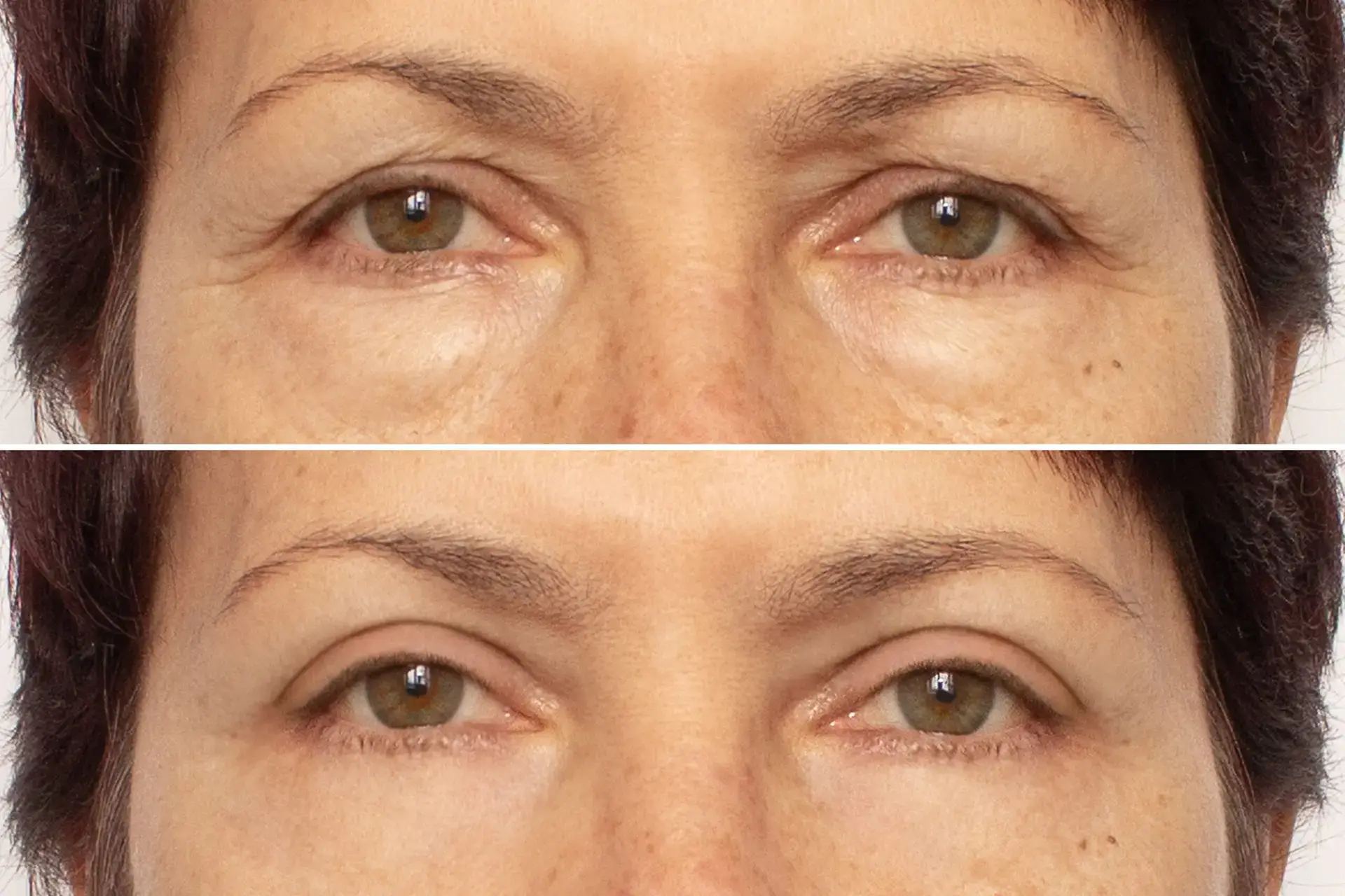 Face and Eyelid Aesthetics Surgery in Turkey
