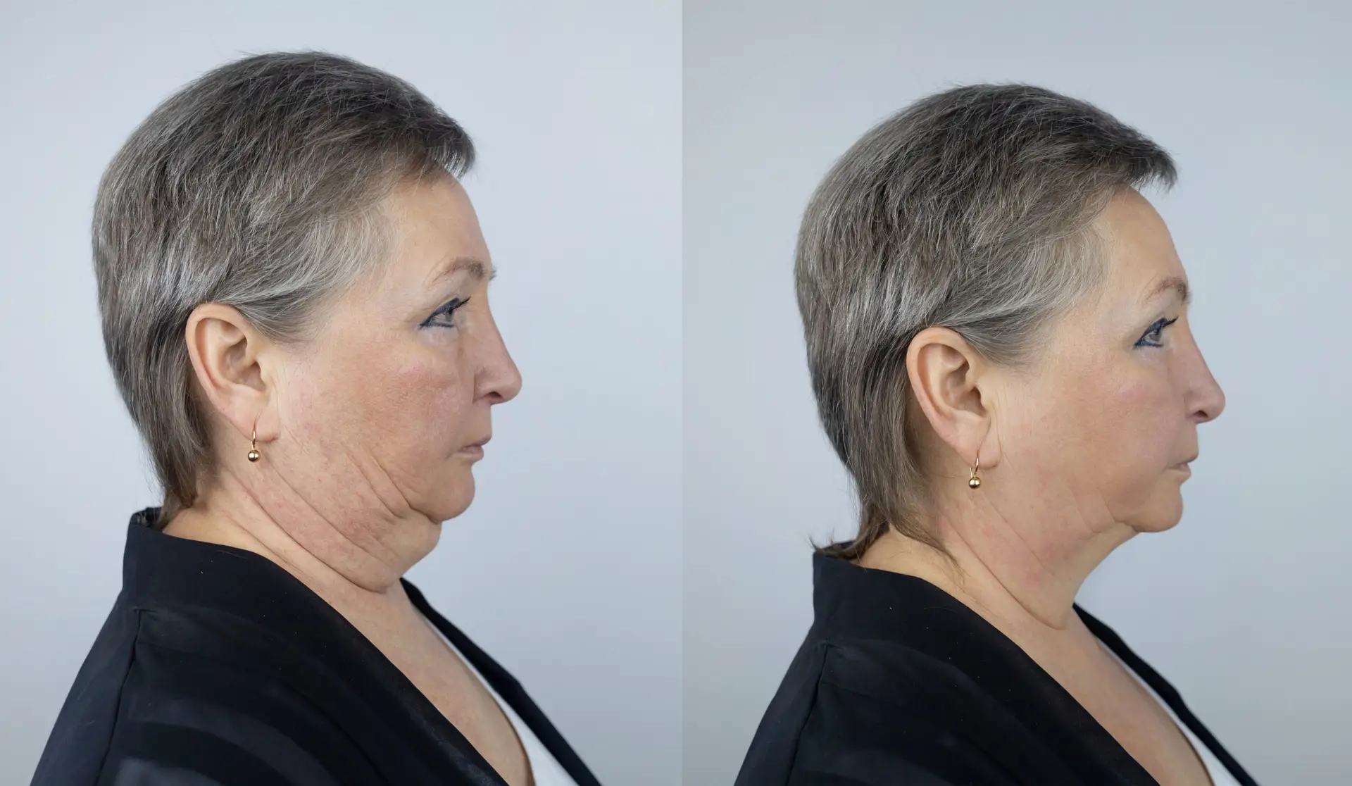 Face Lifting in San Jose