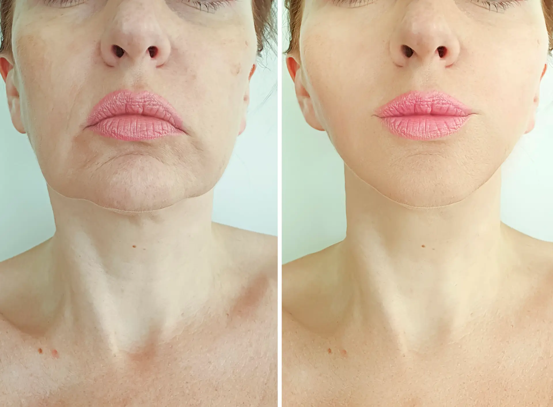 Face Lifting in San Jose