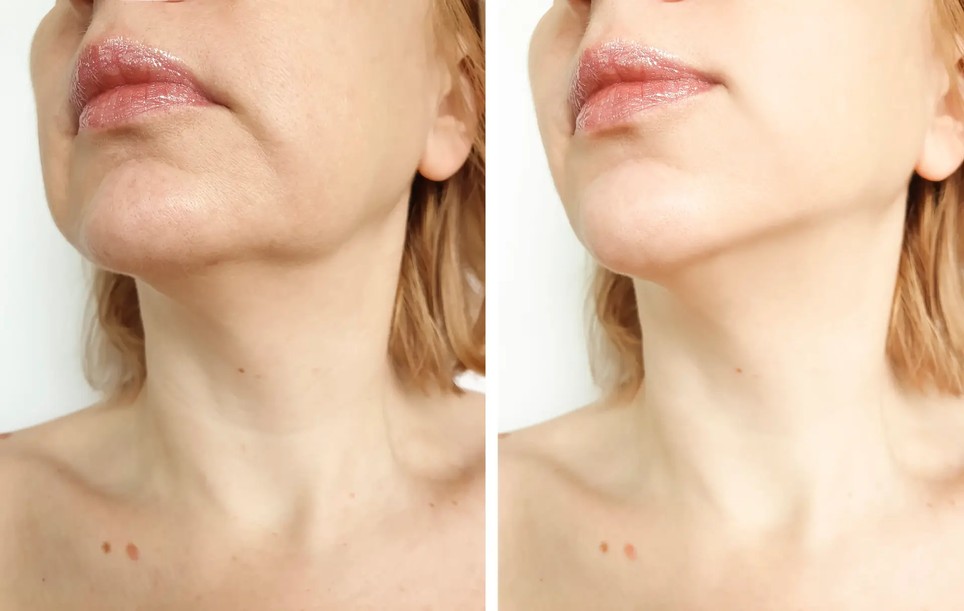 Face Lifting in San Jose