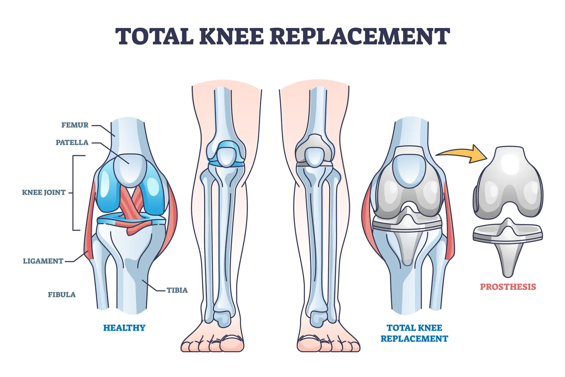 Joint Replacement in Panama