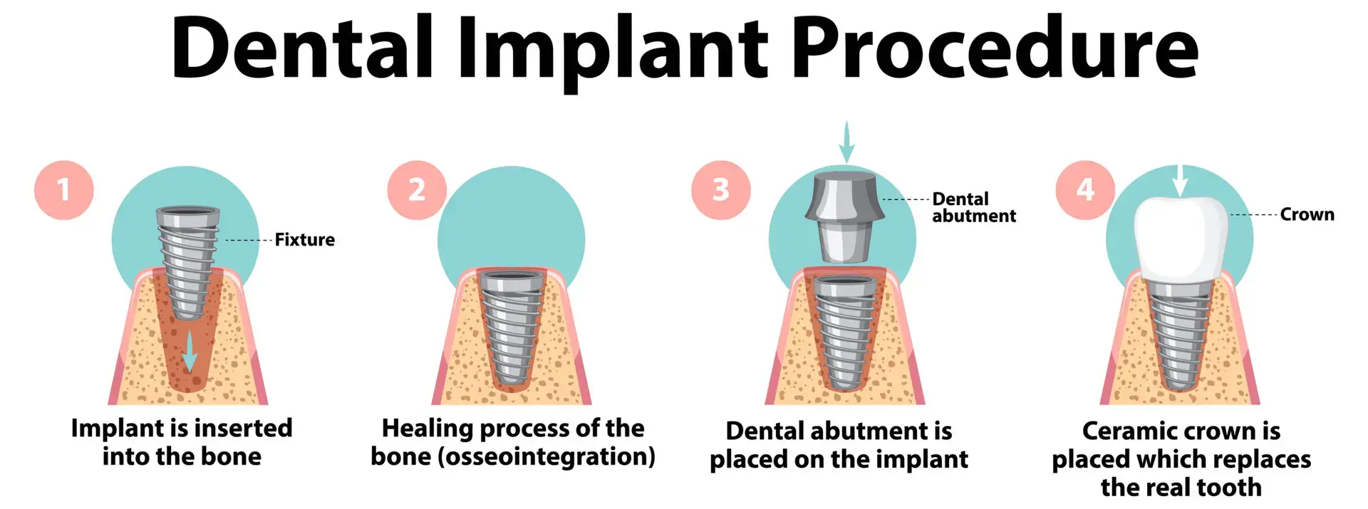 Dental Implant in Singapore
