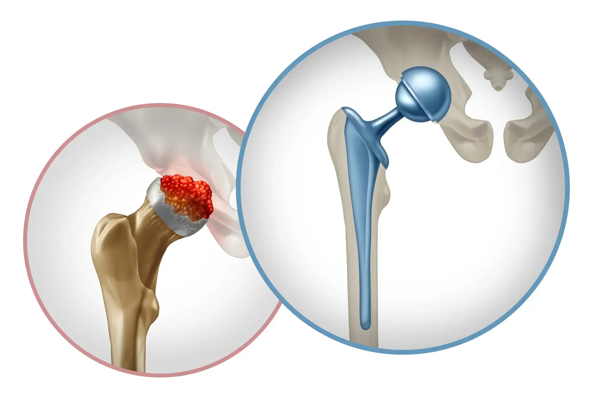 Joint Replacement in Panama