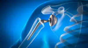 Revision Joint Replacement Surgery in San José, Costa Rica by Dr. Aria Alexander Ravery Morovati at Dr. Aria Alexander Ravery Morovati — Orthopedics Procedure Abroad