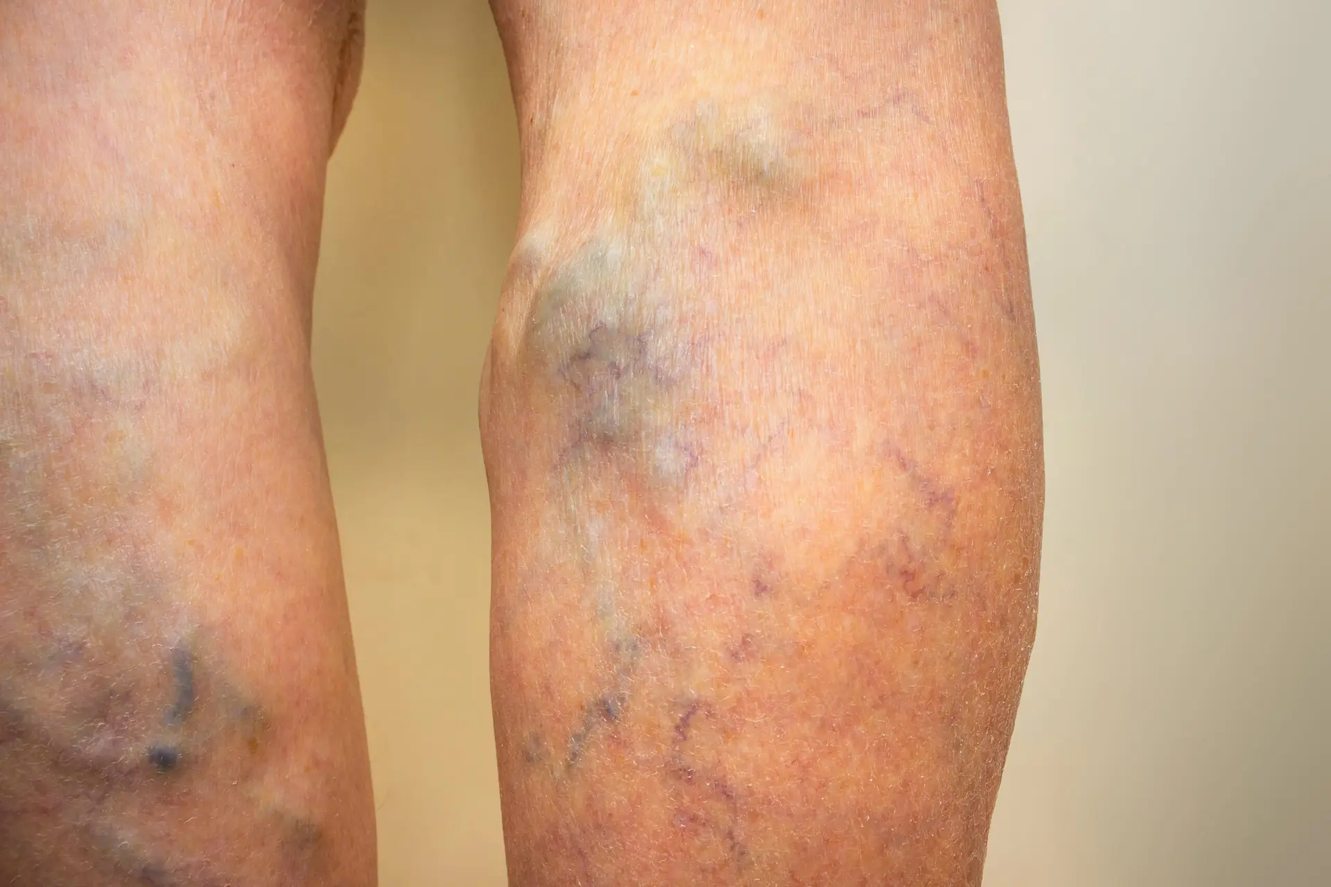 Vein Treatment in San Jose — Procedure Gallery Photo