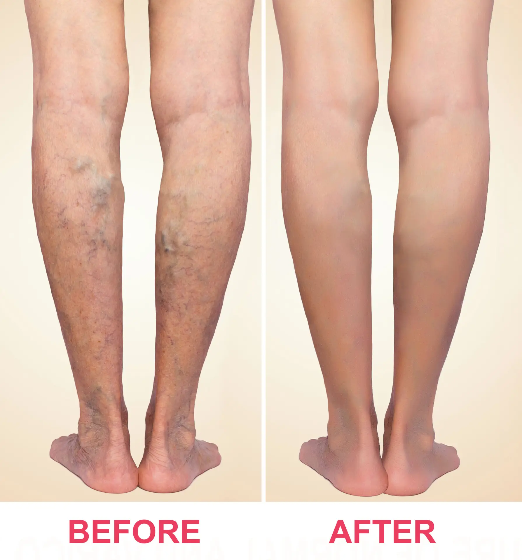 Vein Treatment in San Jose — Procedure Gallery Photo